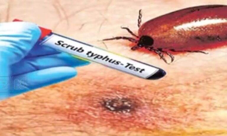 1988005-scrub-typhus